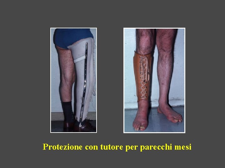 Protezione con tutore per parecchi mesi 