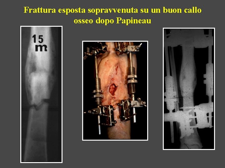 Frattura esposta sopravvenuta su un buon callo osseo dopo Papineau 