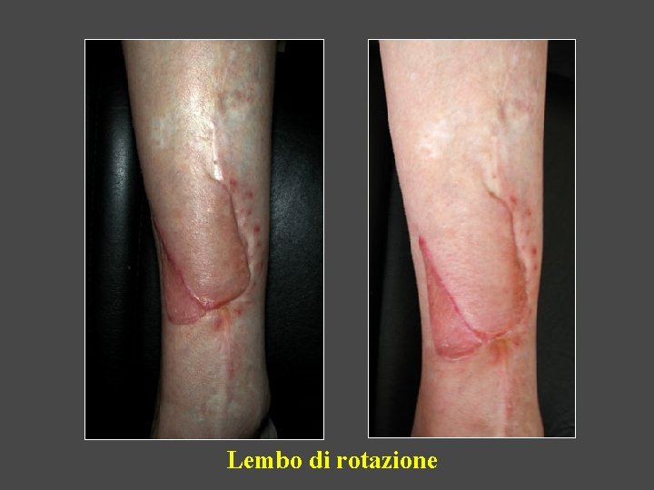 Lembo di rotazione 