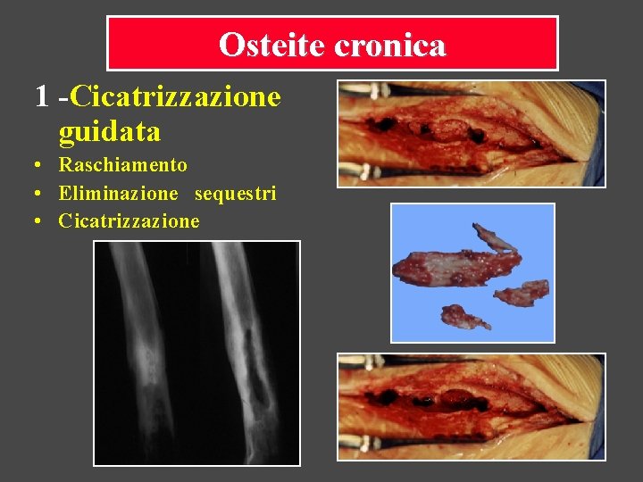 Osteite cronica 1 -Cicatrizzazione guidata • Raschiamento • Eliminazione sequestri • Cicatrizzazione 