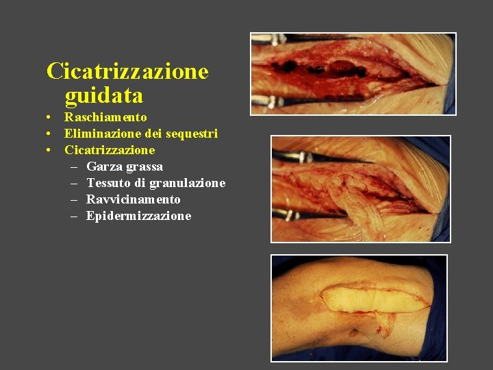 Cicatrizzazione guidata • Raschiamento • Eliminazione dei sequestri • Cicatrizzazione – Garza grassa –