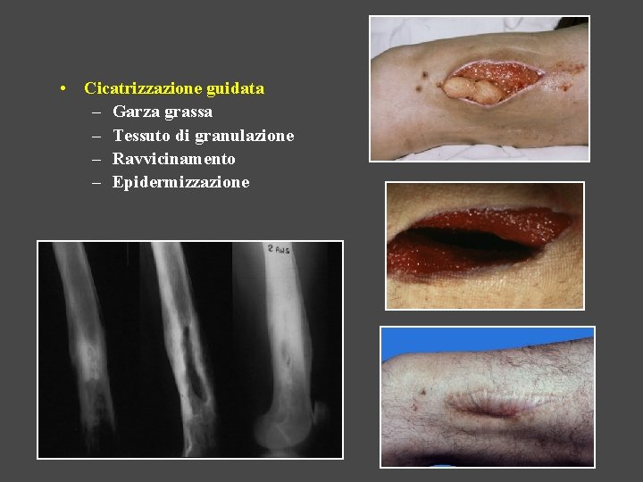  • Cicatrizzazione guidata – Garza grassa – Tessuto di granulazione – Ravvicinamento –