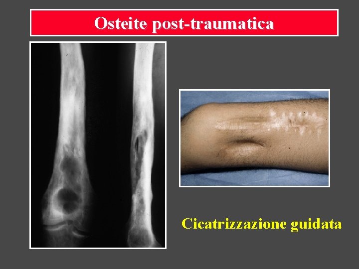Osteite post-traumatica Cicatrizzazione guidata 
