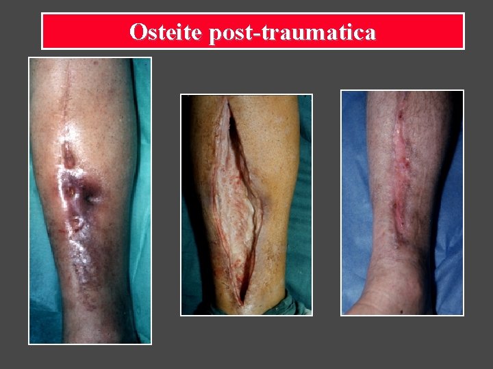 Osteite post-traumatica 