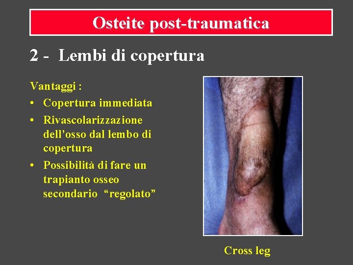 Osteite post-traumatica 2 - Lembi di copertura Vantaggi : • Copertura immediata • Rivascolarizzazione