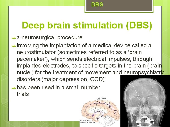 DBS Deep brain stimulation (DBS) a neurosurgical procedure involving the implantation of a medical