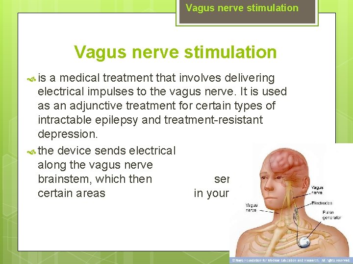 Vagus nerve stimulation is a medical treatment that involves delivering electrical impulses to the