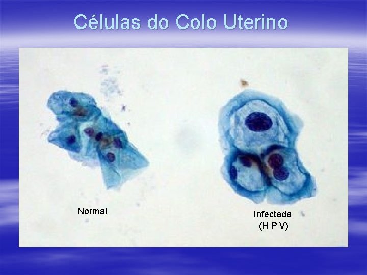 Células do Colo Uterino Normal Infectada (H P V) 
