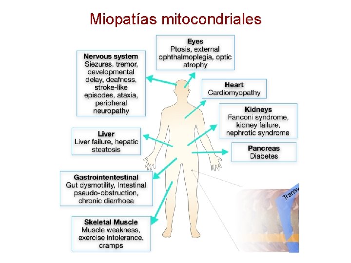 Miopatías mitocondriales 