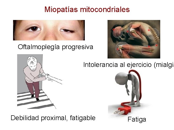 Miopatías mitocondriales Oftalmoplegía progresiva Intolerancia al ejercicio (mialgia Debilidad proximal, fatigable Fatiga 