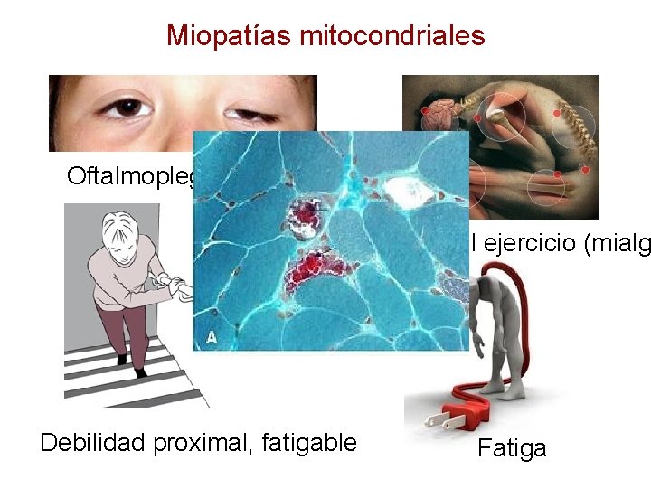 Miopatías mitocondriales Oftalmoplegía progresiva -Intolerancia al ejercicio (mialg Debilidad proximal, fatigable Fatiga 