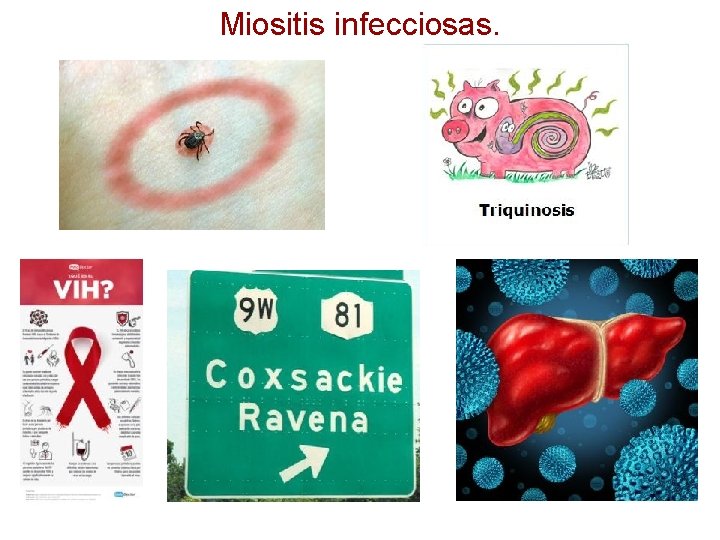 Miositis infecciosas. 