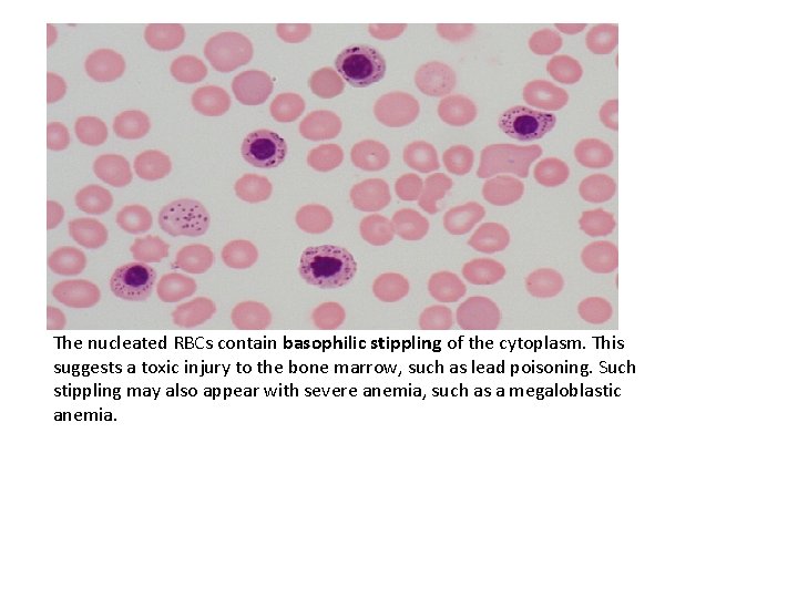 The nucleated RBCs contain basophilic stippling of the cytoplasm. This suggests a toxic injury