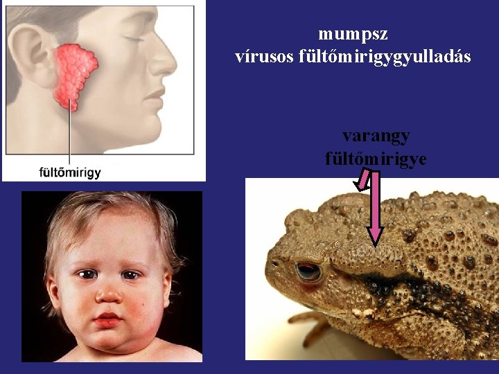 mumpsz vírusos fültőmirigygyulladás varangy fültőmirigye 