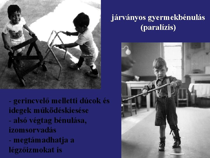 járványos gyermekbénulás (paralízis) - gerincvelő melletti dúcok és idegek működéskiesése - alsó végtag bénulása,