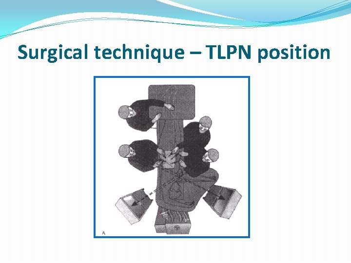 Surgical technique – TLPN position 