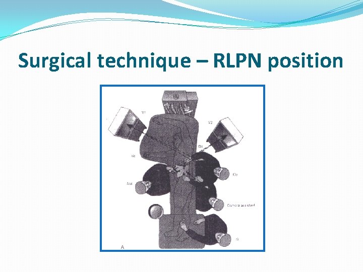 Surgical technique – RLPN position 