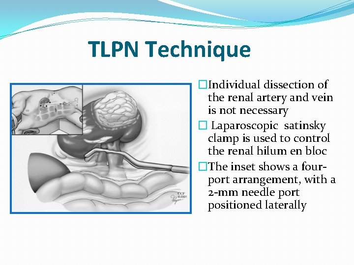 TLPN Technique �Individual dissection of the renal artery and vein is not necessary �