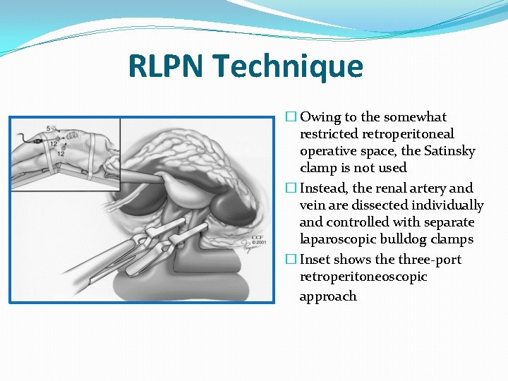 RLPN Technique � Owing to the somewhat restricted retroperitoneal operative space, the Satinsky clamp