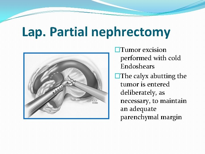 Lap. Partial nephrectomy �Tumor excision performed with cold Endoshears �The calyx abutting the tumor