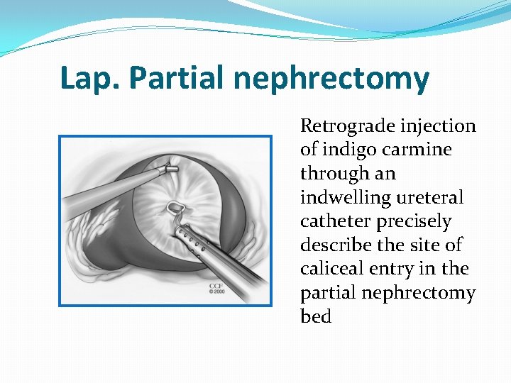 Lap. Partial nephrectomy Retrograde injection of indigo carmine through an indwelling ureteral catheter precisely