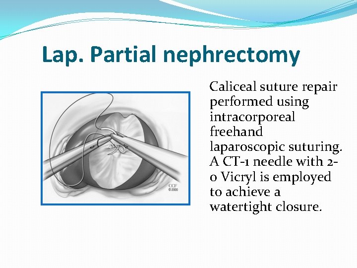 Lap. Partial nephrectomy Caliceal suture repair performed using intracorporeal freehand laparoscopic suturing. A CT-1