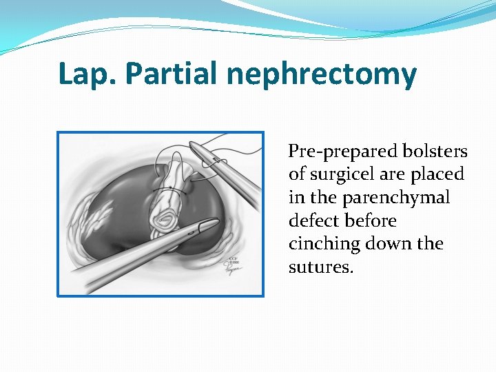Lap. Partial nephrectomy Pre-prepared bolsters of surgicel are placed in the parenchymal defect before