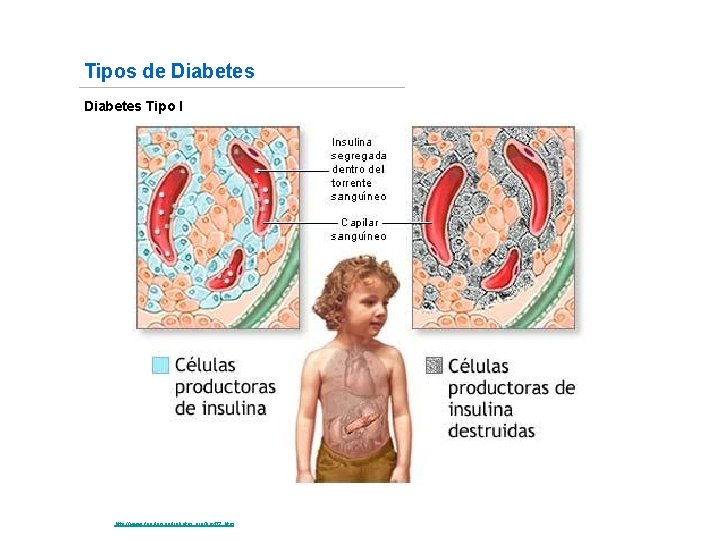 Tipos de Diabetes Tipo I Fuente: http: //www. fundaciondiabetes. org/box 02. htm 