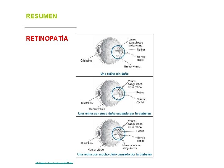 RESUMEN RETINOPATÍA Fuente: http: //www. fundaciondiabetes. org/box 02. htm 