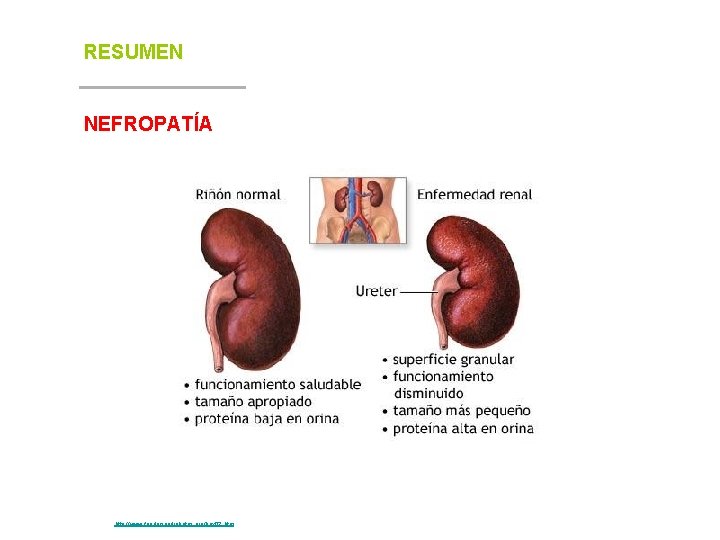 RESUMEN NEFROPATÍA Fuente: http: //www. fundaciondiabetes. org/box 02. htm 