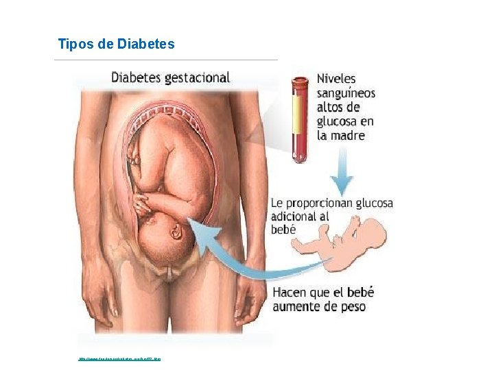 Tipos de Diabetes Fuente: http: //www. fundaciondiabetes. org/box 02. htm 