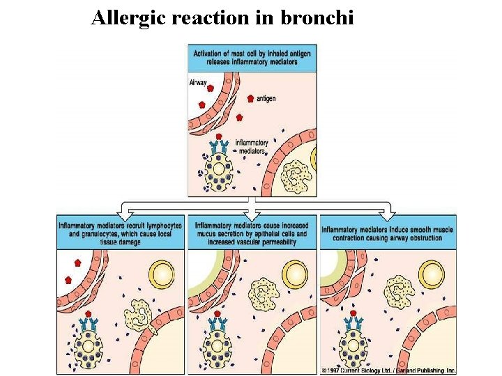 Allergic reaction in bronchi Allergic reaction in bronchi
