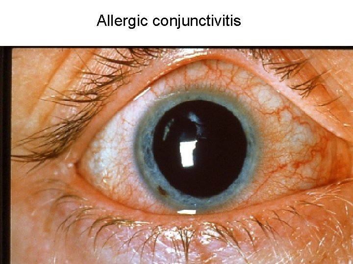 Allergic conjunctivitis Allergic conjunctivitis