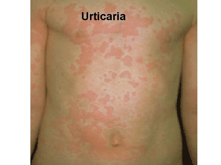 Urticaria Urticaria