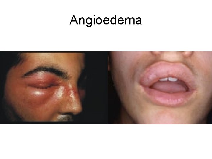 Angioedema Angioedema
