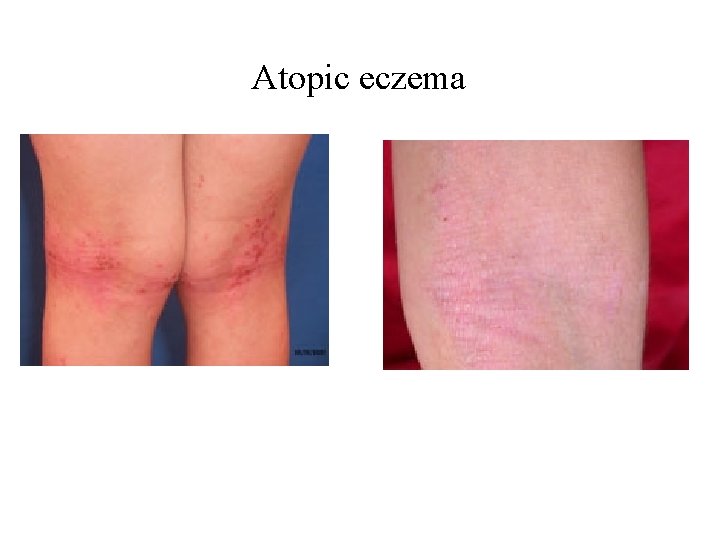 Atopic eczema Atopic eczema