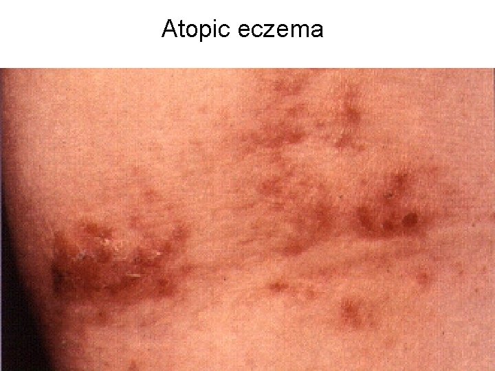 Atopic eczema Atopic eczema