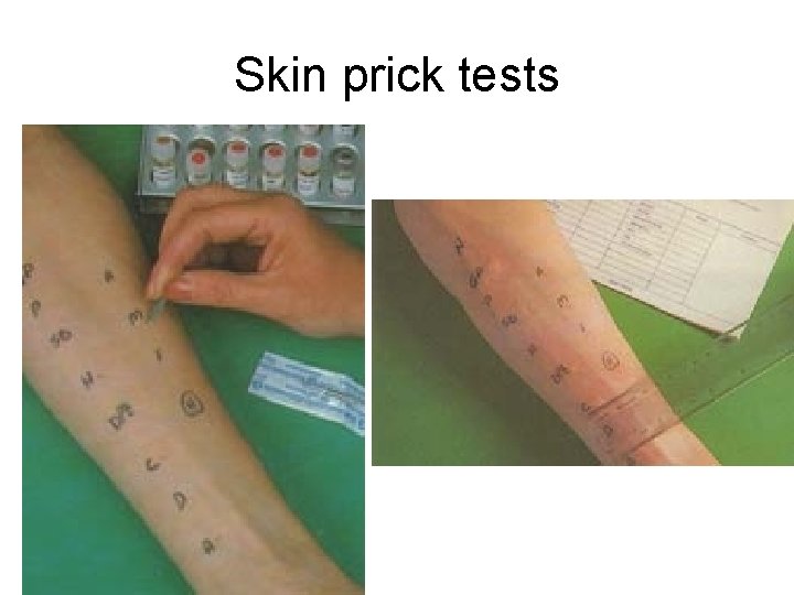 Skin prick tests Skin prick tests