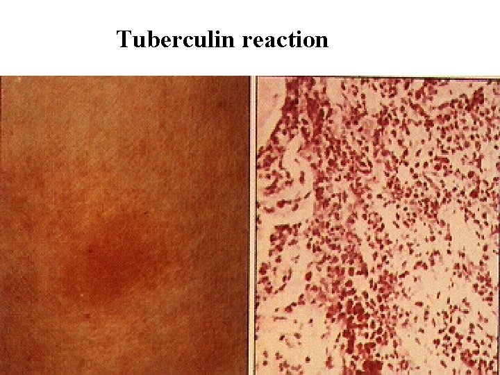 Tuberculin reaction Tuberculin reaction