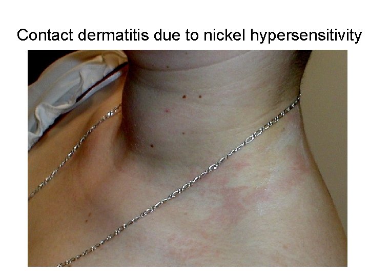 Contact dermatitis due to nickel hypersensitivity Contact dermatitis due to nickel hypersensitivity