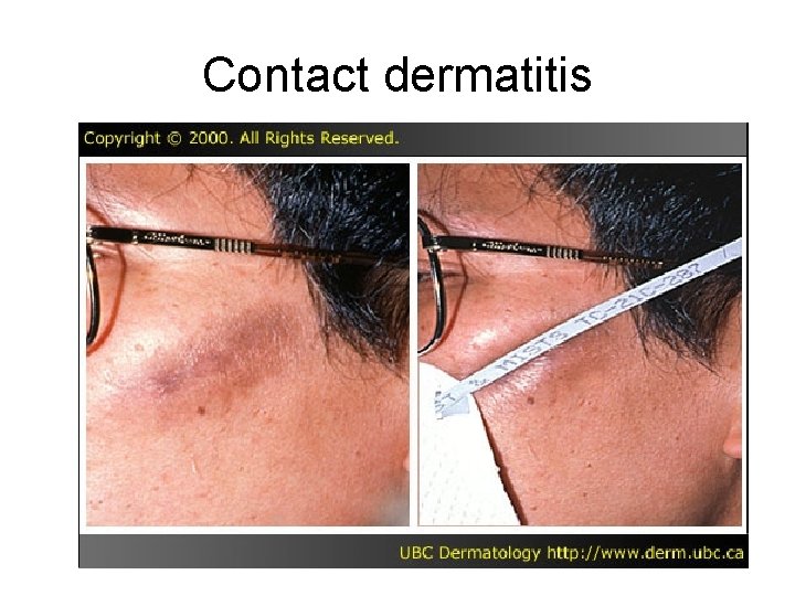 Contact dermatitis Contact dermatitis