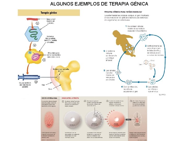 ALGUNOS EJEMPLOS DE TERAPIA GÉNICA 