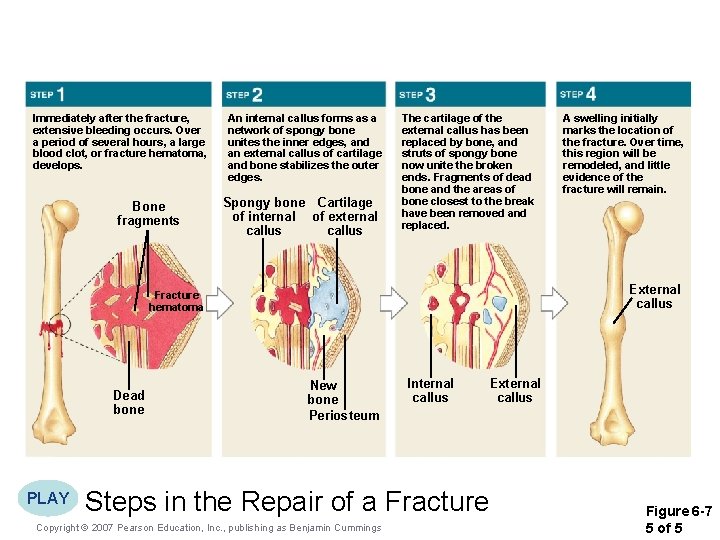Immediately after the fracture, extensive bleeding occurs. Over a period of several hours, a Immediately after the fracture, extensive bleeding occurs. Over a period of several hours, a
