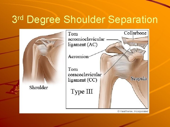 3 rd Degree Shoulder Separation 