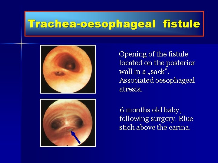 trachealis papillomatosis icd 10