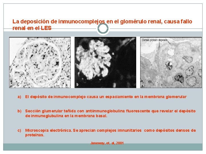 La deposición de inmunocomplejos en el glomérulo renal, causa fallo renal en el LES