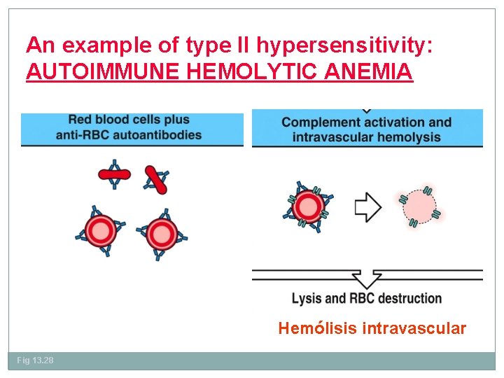 An example of type II hypersensitivity: AUTOIMMUNE HEMOLYTIC ANEMIA Hemólisis intravascular Fig 13. 28
