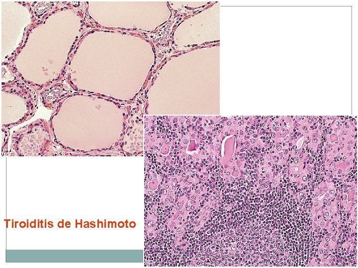 Tiroiditis de Hashimoto 