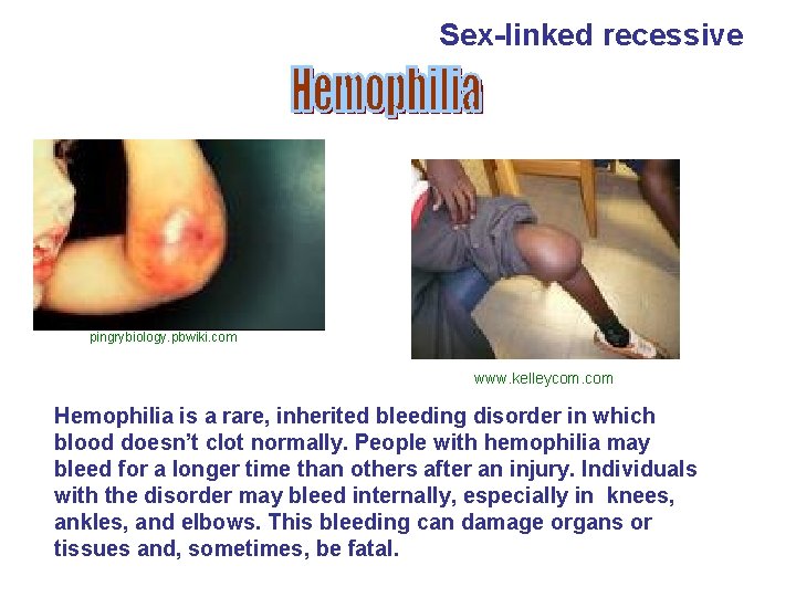 Sex-linked recessive pingrybiology. pbwiki. com www. kelleycom. com Hemophilia is a rare, inherited bleeding