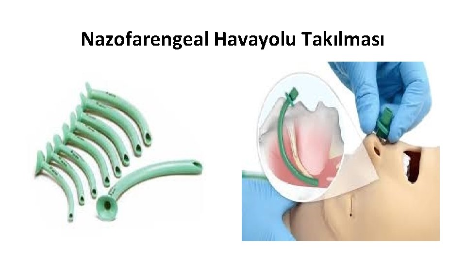 Nazofarengeal Havayolu Takılması 